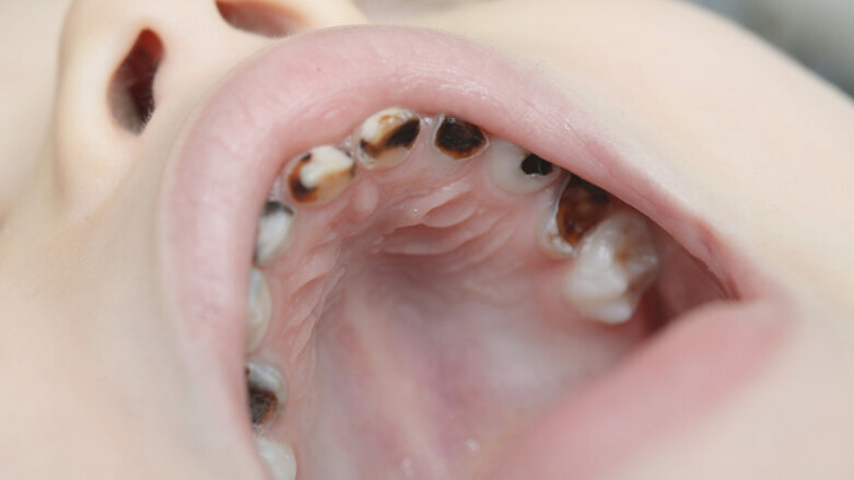 Early preventive dental care may not reduce caries risk