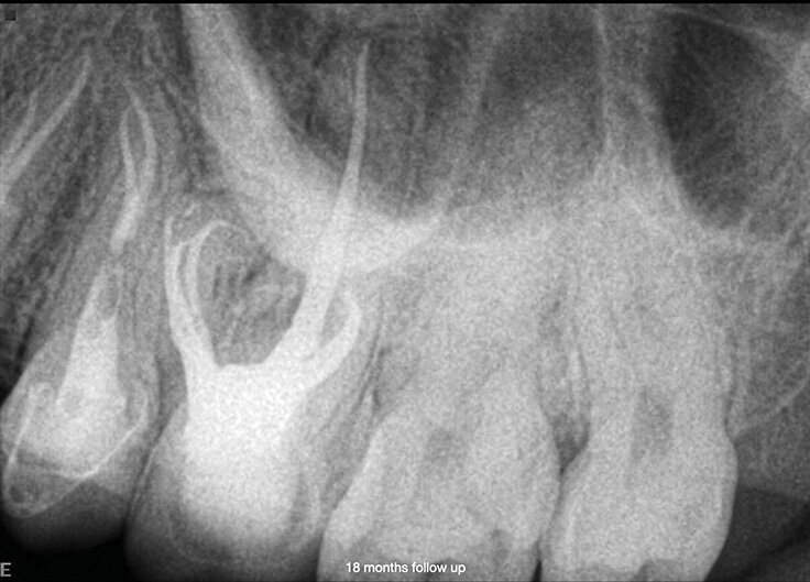 Slučaj 3 – Slika br. 11: Periapikalni kontrolni Rtg snimak 18 meseci nakon tretmana