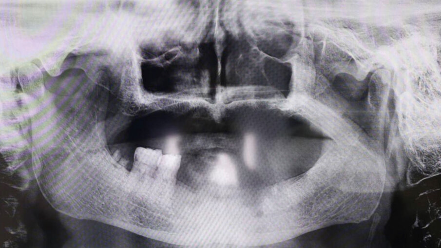 Fig. 3 - RX iniziale. Il Paziente ottantenne si presenta con una protesi mobile realizzata e inserita da oltre 20 anni. Il desiderio di avere i denti fissi non l’ha mai abbandonato. Dalla RX si evince la chiara assenza totale di osso, situazione che non permette l’inserimento degli impianti in titanio tramite intervento tradizionale. Questo caso è stato affrontato tramite l’inserimento del Premaxillary Device.