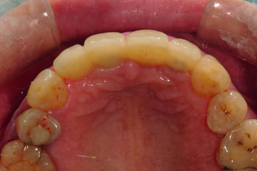 Fig. 22: ICP contact on tooth #13 after reshaping of the lingual surface with resin (12 μm occluding paper, red).