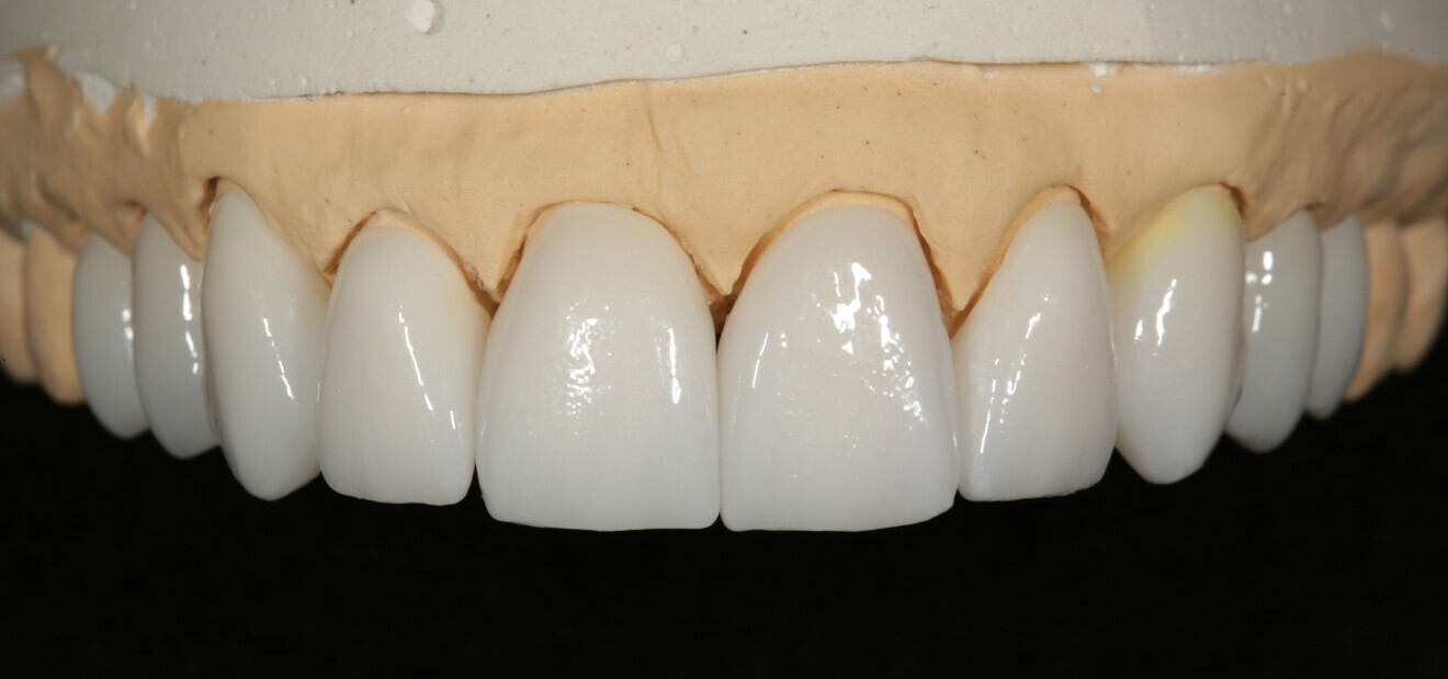 Fig. 20: Definitive zirconia restorations on the master model.