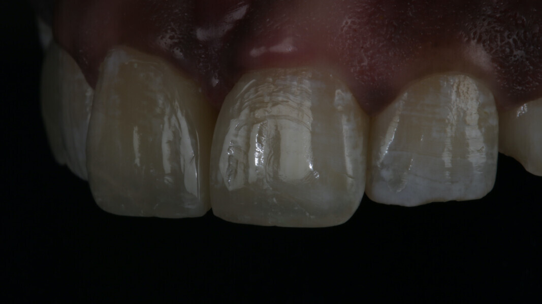 Fig 27. The textures were well replicated and gave the life-like appeal to final restoration.