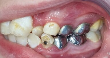 Wie moet het cariësprobleem oplossen?