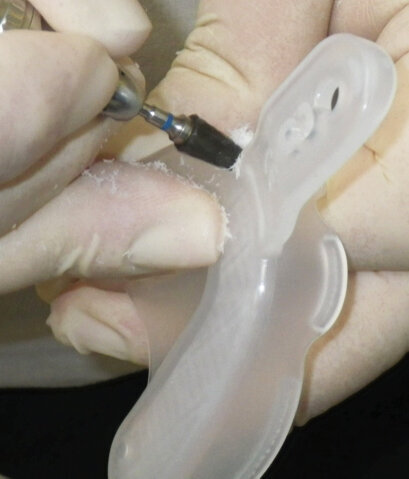 Fig. 4. An acrylic bur is being used to cut a hole in the tray to access the impression screw.
