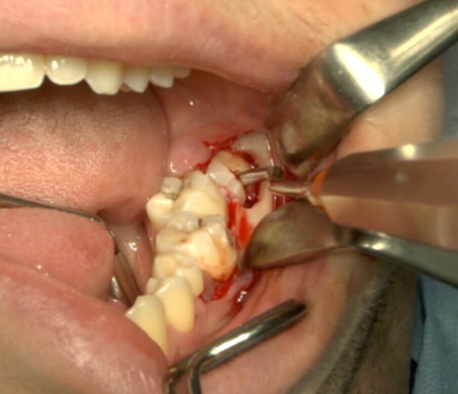 Fig. 9_Frattura della corona sezionata mediante leva dritta.