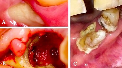 Estrategias para prevenir la osteonecrosis maxilar inducida por medicamentos