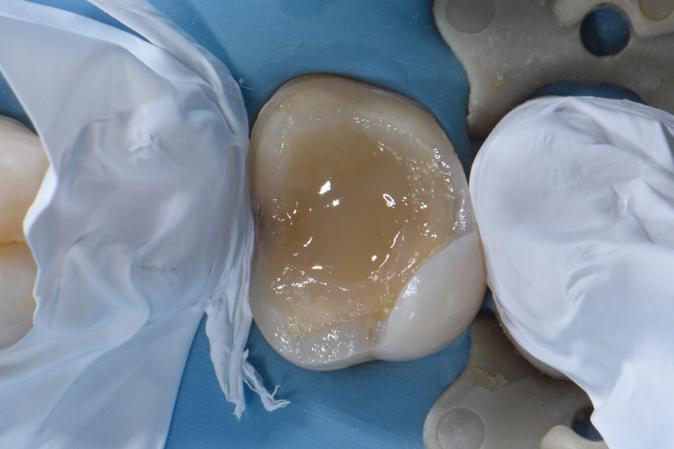 Fig. 23: Core build-up completed with a radiopaque composite.