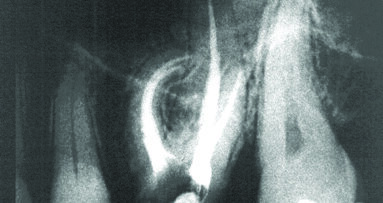Taktilna percepcija u endodonciji