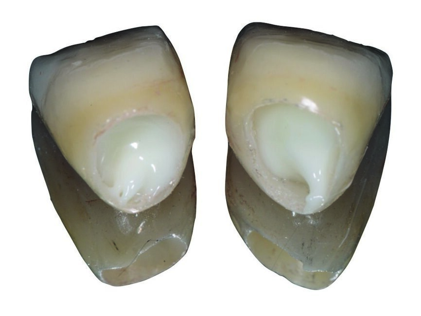 Fig. 8 : Couronnes en zircone pour les incisives centrales supérieures remplies de ciment verre ionomère modifié par adjonction de résine. 