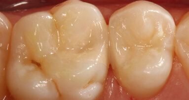 Long-term restorative glass hybrids—eco-friendly and cost-effective evolution from GC