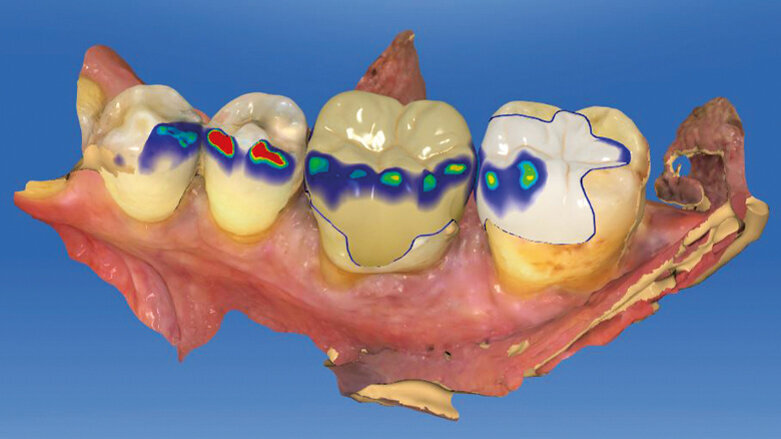 Vyfrézovat, vyleštit, nasadit! Nepřímé procedury ve stomatologickém workflow