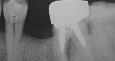 Guarigione di un alveolo post-estrattivo per seconda intenzione con membrana in pericardio equino