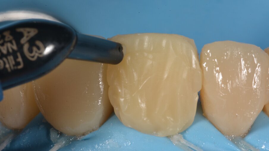 De resterende holte werd via buccaal verder in laagjes opgevuld.