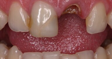 Perno anatómico para la reconstrucción radicular