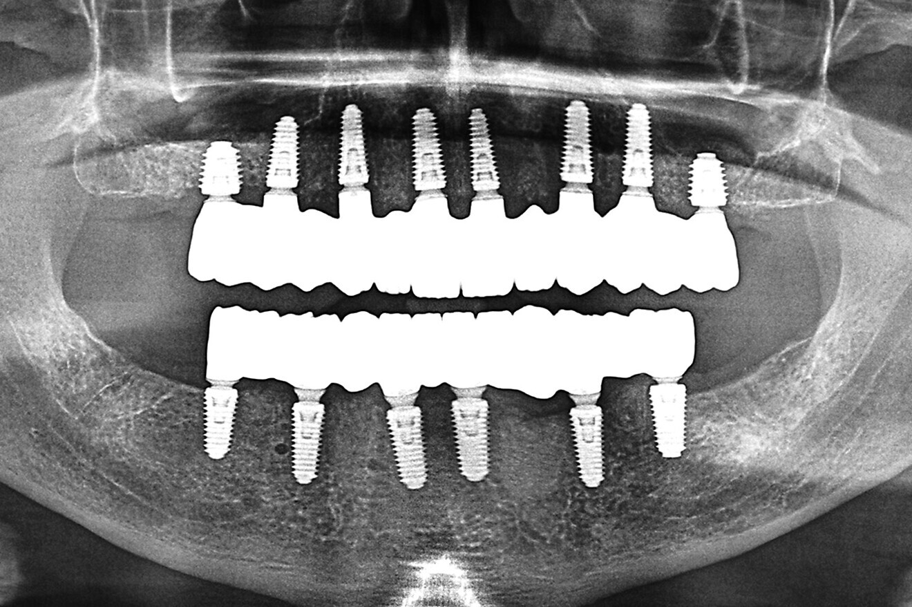 Fig. 17a: Final panoramic radiograph confirming seating of the zirconia restorations.