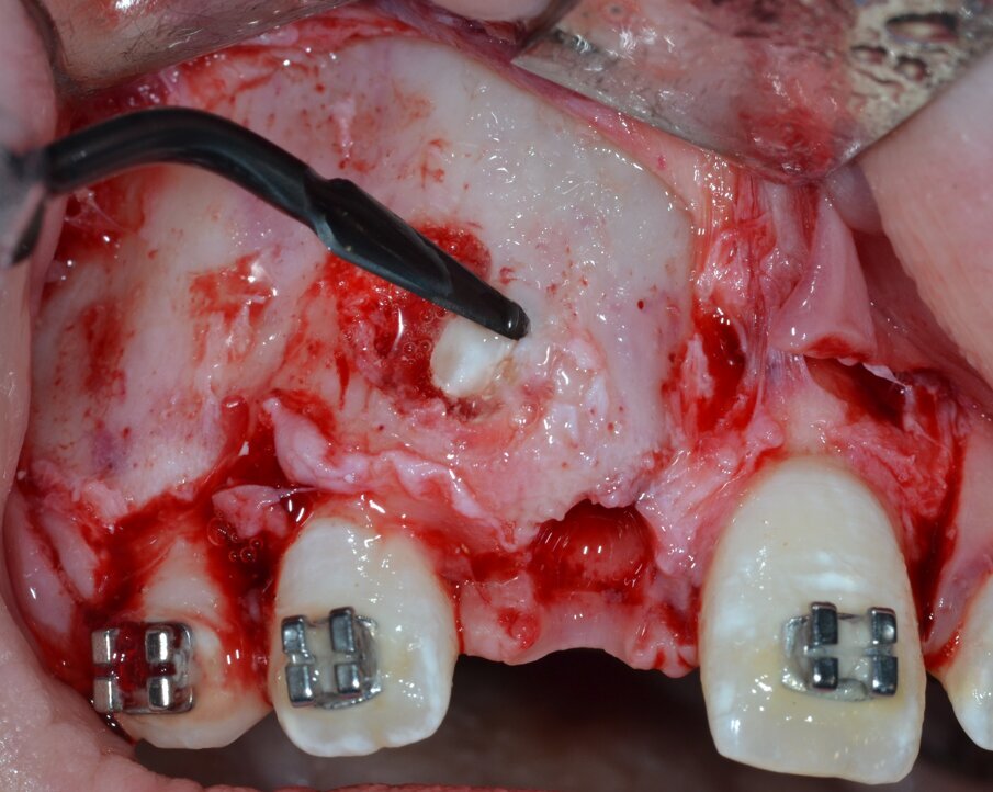 Fig. 7_Osteotomia perilesionale che segue il contorno della neoformazione.