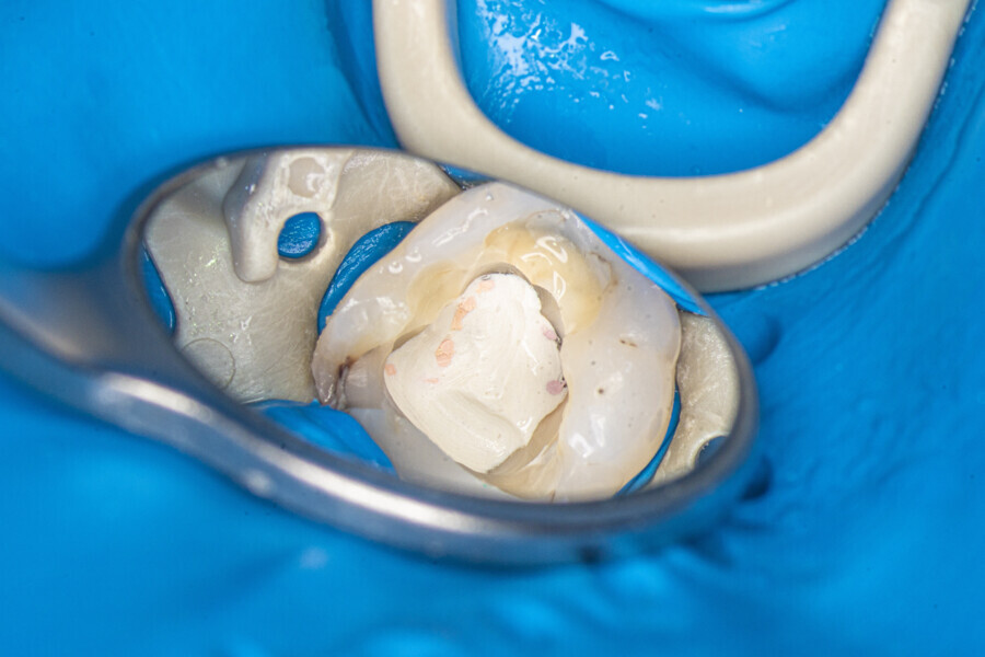 Fig. 15: Tooth after removal of the composite restoration.