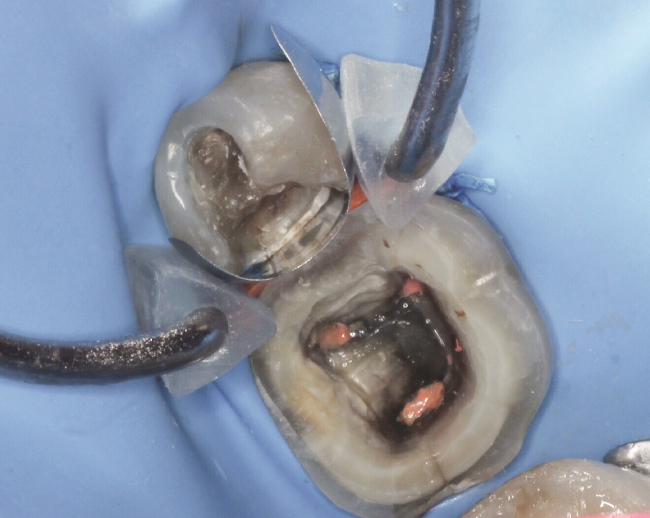 Fig. 3: Matrix system positioned for correct adaptation of the margin on tooth #45.