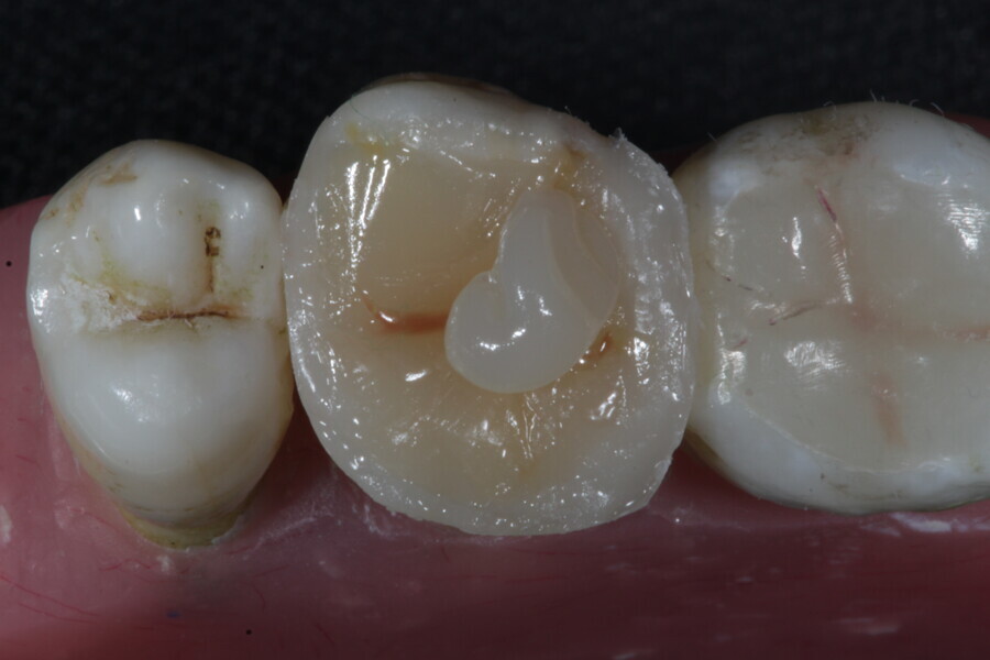 Fig. 43a: The dentine composite layer (Estelite) is covered with an aesthetic enamel layer.