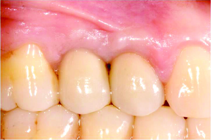 Fig. 12-14_Corone definitive e rx di controllo a due anni dalla chirurgia.