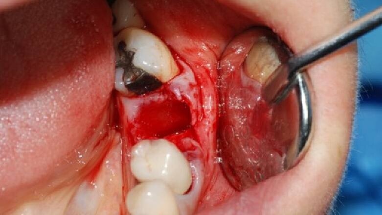 Utilizzo di osso bovino decellularizzato e delipidato e di una membrana in pericardio