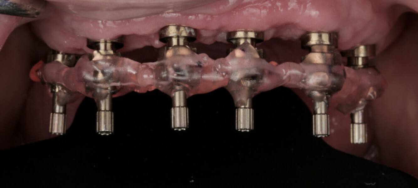 Fig. 17: Splinted open-tray impression copings.