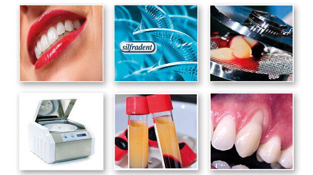 Workshop Silfradent: Concentrated Growth Factors (CGF) nella rigenerazione ossea e tessutale, aumenti di cresta orizzontali e verticali