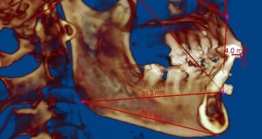 Nova tecnologia melhora alinhamento da mandíbula e dos dentes em pacientes submetidos a transplante facial