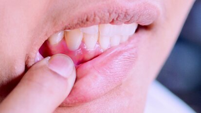 Un nuovo studio spiega il legame tra obesità e malattia parodontale