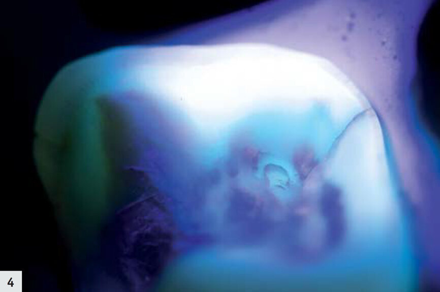 Figs. 4–5 : On peut observer une fissure très fine dont l’aspect est légèrement sombre ; aucune activité bactérienne n’est visible. 