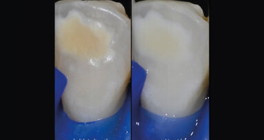 Sbiancamento dentale in età adolescenziale: approccio clinico minimamente invasivo grazie alle nuove formulazioni domiciliari Blancone