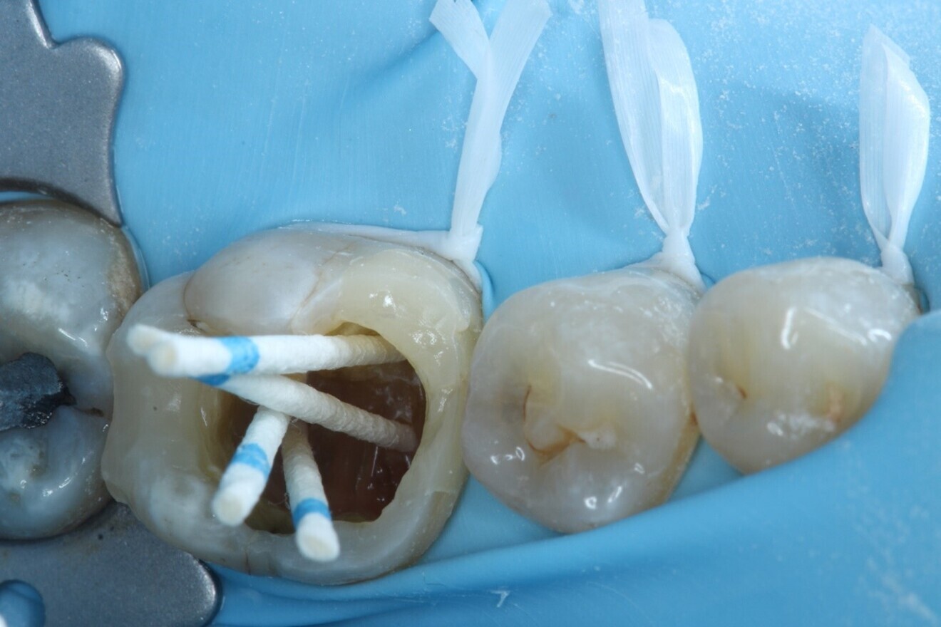 Fig. 10: Canals being dried using Hyflex EDM paper points.