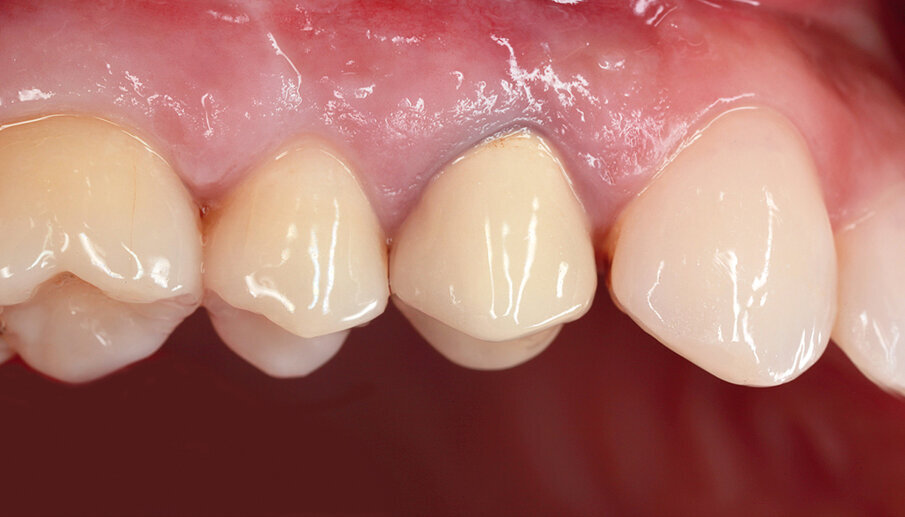 Fig. 35: The tooth had already been endodontically treated and restored with a PFM crown. After a root fracture, it could no longer be preserved.