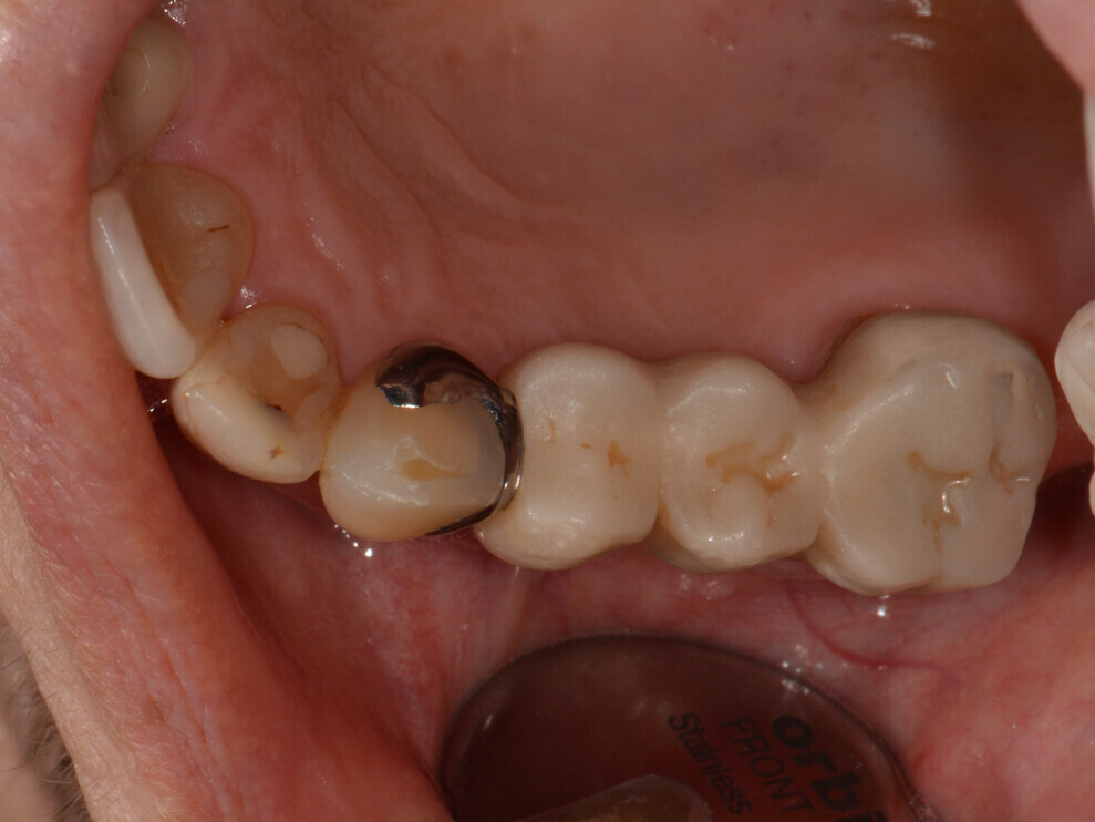 Fig. 1: Before treatment. Provisional bridge from tooth #13 to tooth #16.