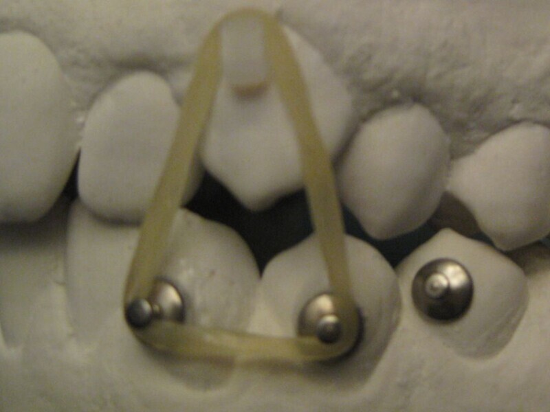 Fig. 8: Inter-arch elastic–button technique.