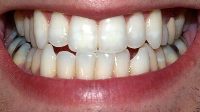 Rješenje za škripanje sa zubima