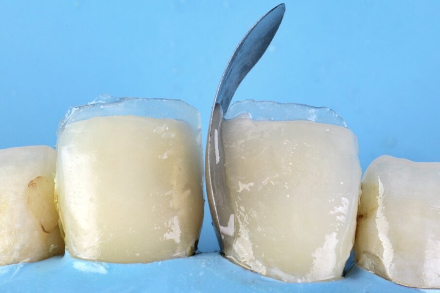 Fig. 7: Sectional matrix band placed and stabilized with Beautifil II Enamel shade HVT (High Value Translucent).