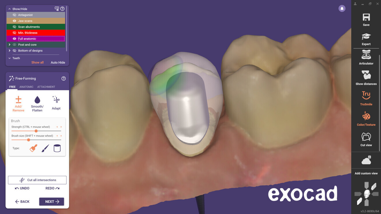 Users can design post-and-core restorations so that a crown matching the core can be designed in the same step