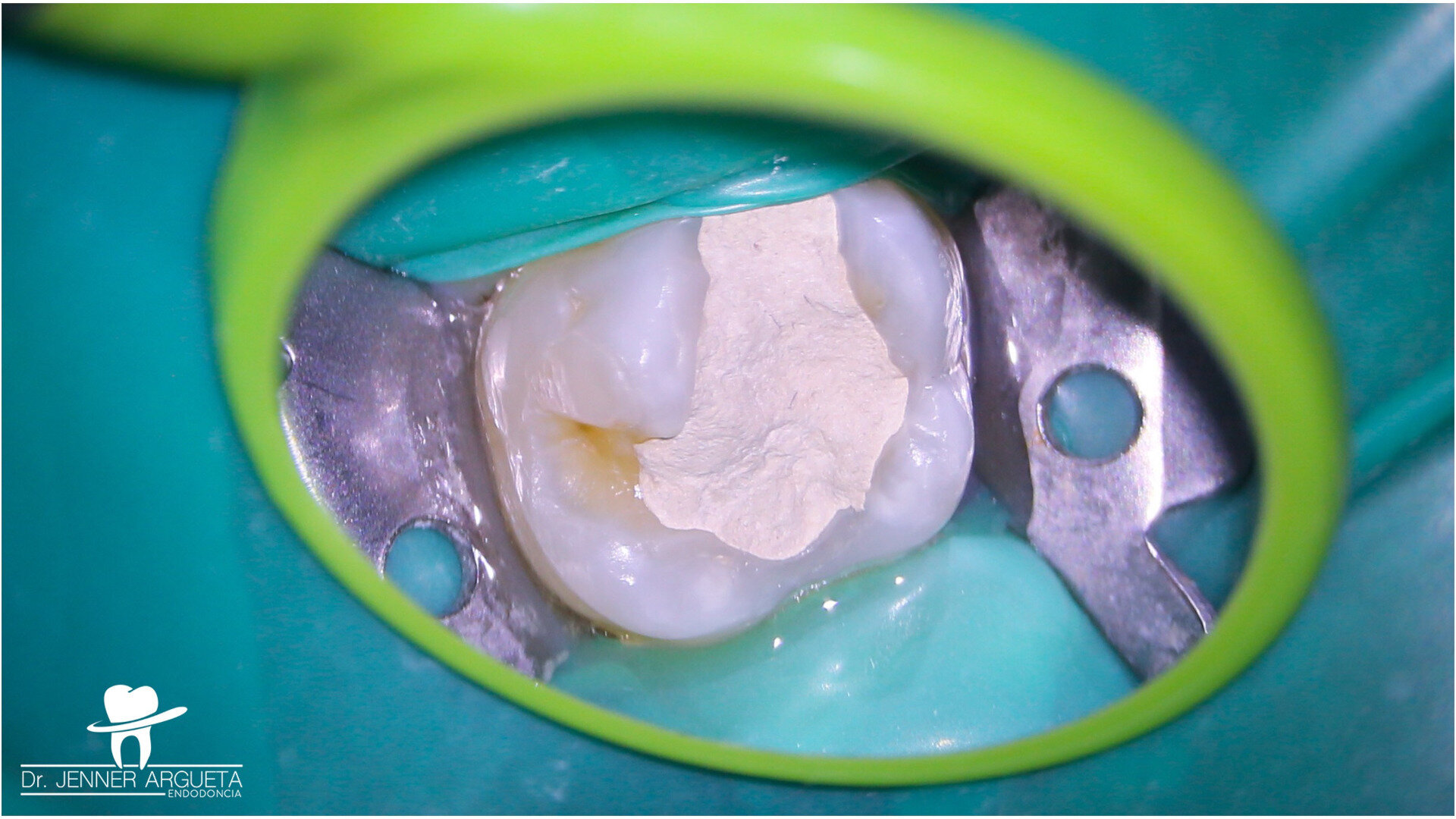 Vital pulp therapy—the clinical perspective