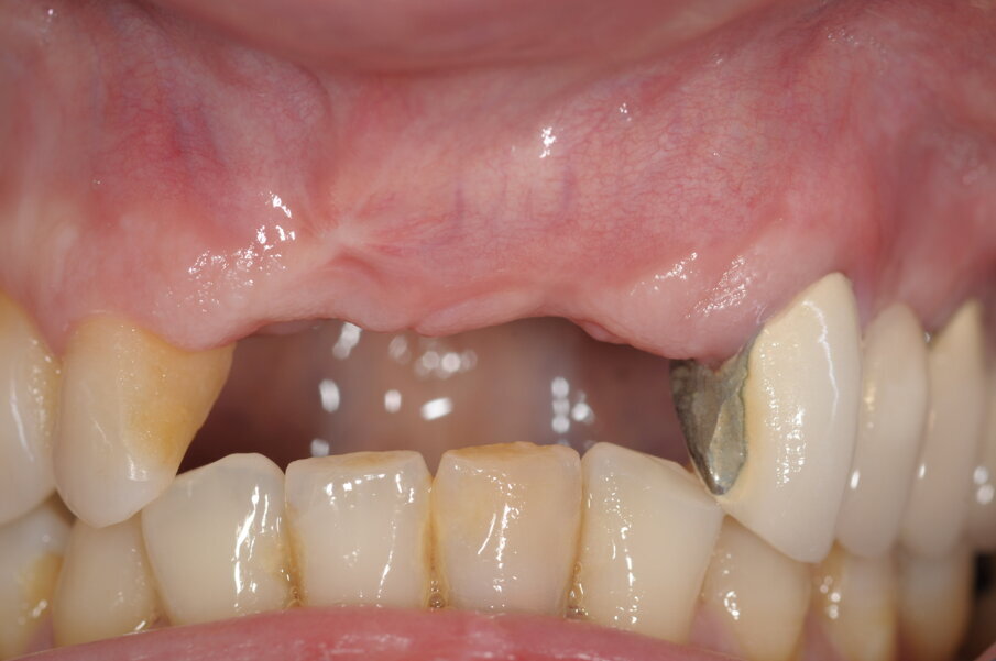 Fig. 14 - Valutazione sito rigenerato in visione frontale.