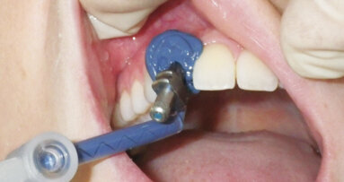 Predictable implant impressions