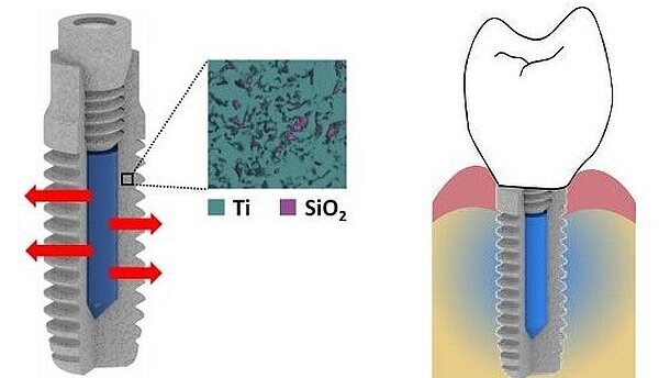 Nieuw implantaat gaat infecties tegen