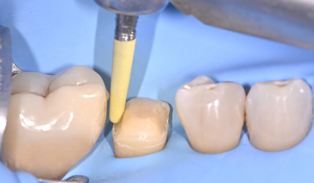 Fig. 9: Polishing of the sealed surface with dedicated instruments. 