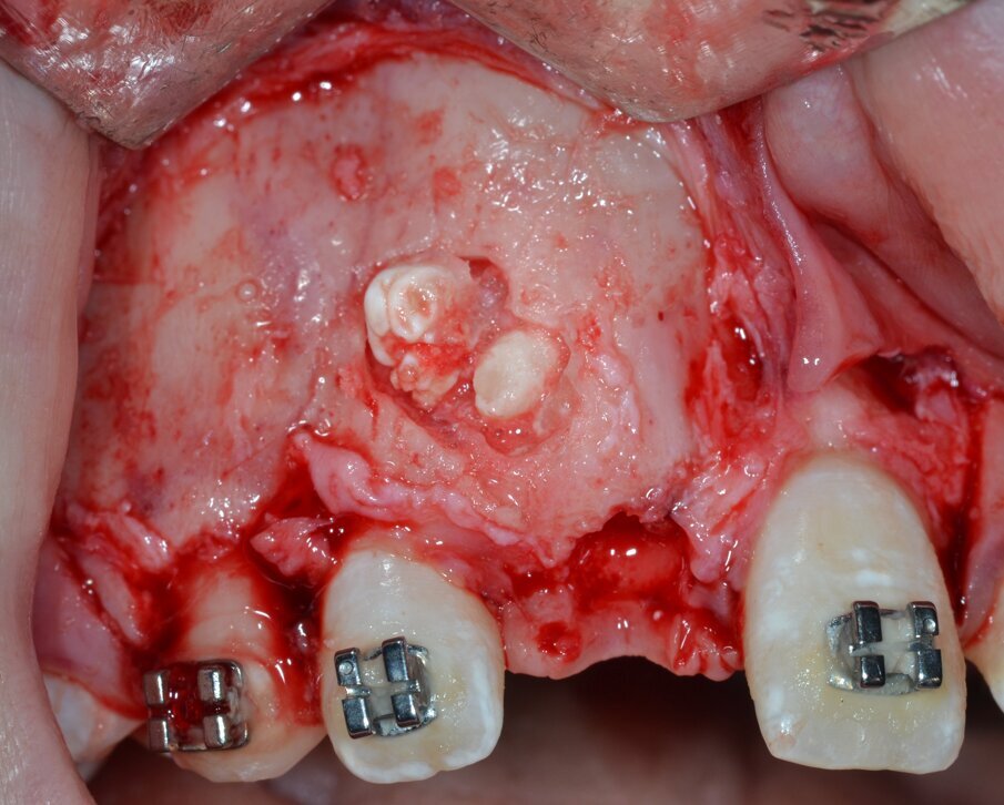 Fig. 8_Esposizione e isolamento della neoformazione.