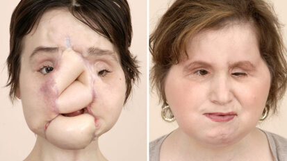 Young woman receives successful face transplant
