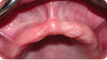 Reconstrucción ósea del máxilar atrófico