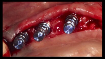 Efecto de la vitamina D en la osteointegración de los implantes dentales