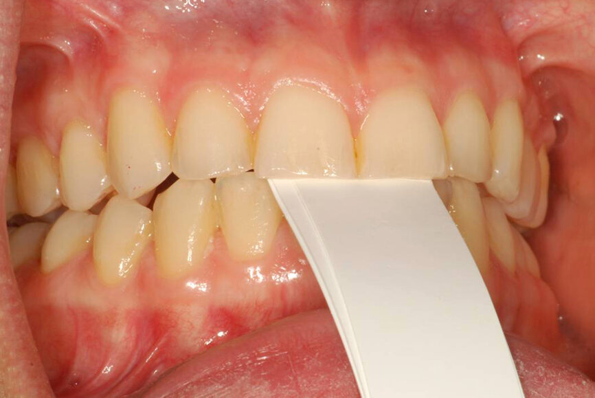 Fig. 8: Leaf gauge creating a disclusion of posterior teeth.