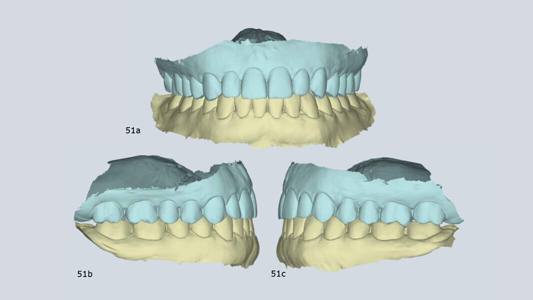 Figs. 51a–c: Virtual articulator mounting with MODJAW demonstrating orthopaedic stability.