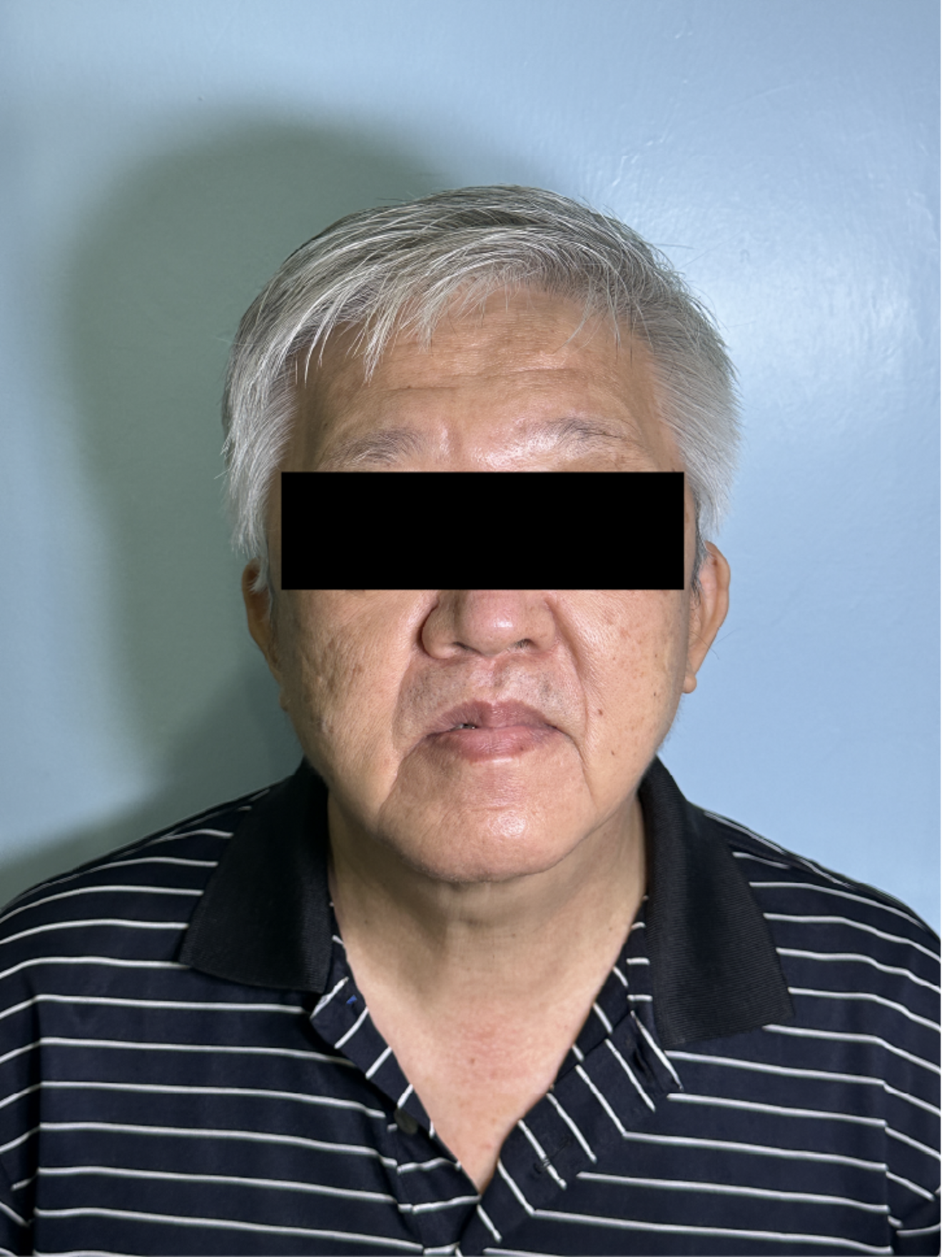 Fig. 1a: Pre-treatment frontal facial view at rest.